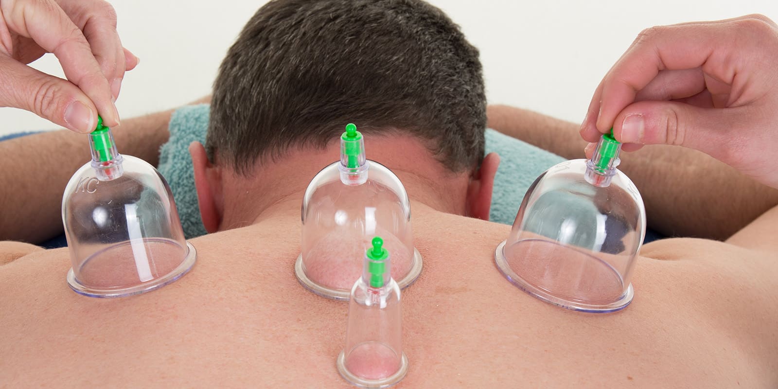 Cupping 1